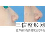 西安鼻翼整形医院排名前八权威点评,2022西安高一生医疗美容医院实力入围
