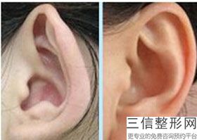 西安耳朵整形医院排名前十实力派,2022西安亚太医疗美容整形医院首次上榜