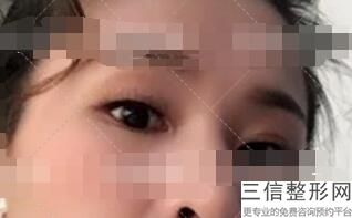 西安割双眼皮哪家好,2022西安高一生整形医院实力入围