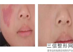 西安拉皮手术哪家好,2022西安画美医疗美容医院不容错过