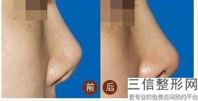 西安隆鼻医生排行榜前五有哪些,2022西安隆鼻医生排行榜前五排名靠前