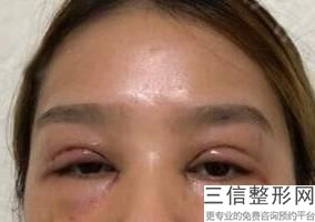 西安哪个医院割双眼皮手术好,2022西安华艺医疗美容医院实力上榜