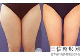 西安哪家医院做大腿吸脂好,2022西安高一生医疗美容医院实力入围