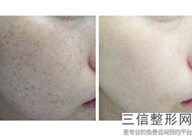 西安热玛吉哪家正规,2022西安画美整形医院锁定前十