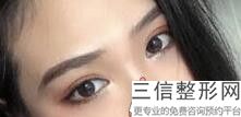 西安双眼皮修复医生排行榜,2022 李跃军医师排名靠前