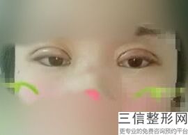 西安双眼皮修复医生排行榜推荐如下,2022舒茂国医生实力非凡