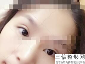 西安双眼皮修复医生排名前五,2022西安双眼皮修复医生排名前五首次上榜