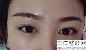 西安双眼皮医院排行榜,2022西安西京医院医疗美容科实力上榜