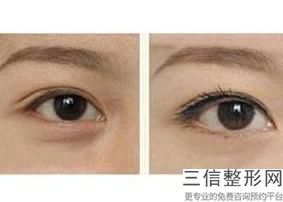 西安双眼皮医院排名前四,2022西安美莱医学美容医院实力非凡