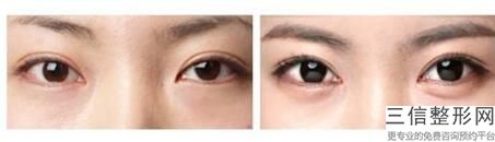 西安西京整形双眼皮排名榜六强权威盘点,2022西安西京医院实力超强