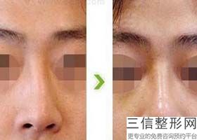 西安修复隆鼻哪家好,2022西安交通大学第一附属医院遥遥领先