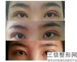 西安眼部整形医生排名前八,2022孙峰医生口碑良好