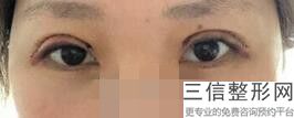 西安眼部整形医院排行前三强出炉了,2022西安长安美容中心医院实力超强