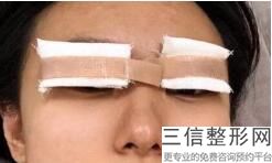 天津双眼皮医生排名榜八强权威公布,2022陈文莉医生实力入围