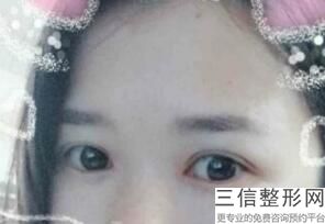 天津双眼皮医生排名前十发布,2022刘雪涛医生口碑良好