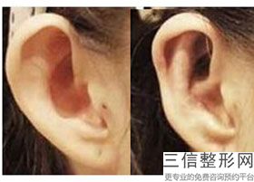 外耳再造全国医院排名榜十强,2022北京同仁医院整形美容中心锁定前十