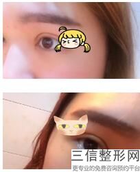 温州双眼皮医生排名哪个好,2022 李力群医生首次上榜