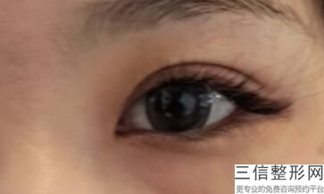 温州双眼皮医生排名前十,2022叶信海不容错过