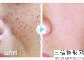 乌鲁木齐哪里可以做热玛吉,2022乌鲁木齐华美整形美容医院锁定前十
