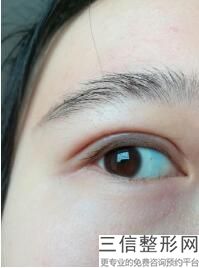 上海九院双眼皮修复较厉害的医生排名前十,2022丁伟副主任医师不容错过