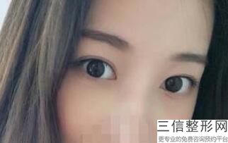 上海九院双眼皮修复专家排名榜,2022刘菲副主任医生遥遥领先