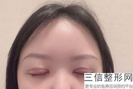 上海九院双眼皮修复专家是谁,2022张路排名靠前