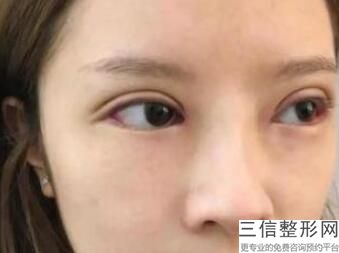上海九院眼部整形医生排名前十强,2022张余光遥遥领先