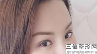 上海九院做双眼皮谁好,2022上海九院魏皎医生做双眼皮案例展示排名靠前