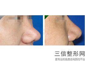 上海隆鼻哪家医院好,2022崔荣达锁定前十