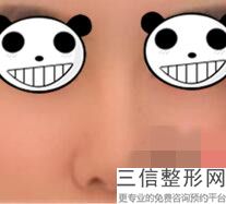 上海隆鼻医生推荐——好的医生才能带来好的整形果,2022叶丽萍不容错过