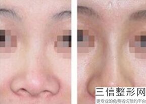 上海隆鼻整形医院权威排行前十,2022上海华美医疗美容整形医院实力超强
