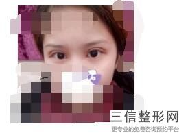 上海埋线双眼皮较好的医院有哪些,2022上海华美整形医院口碑不错