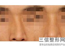 上海美立方做鼻部手术怎么样,2022王志刚锁定前十