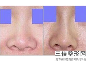 上海哪家隆鼻医院比较好,2022上海仁济医院整形科实力超强