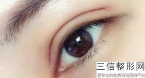 宁波割双眼皮医生哪个好,2022宁波割双眼皮医生排行不容错过