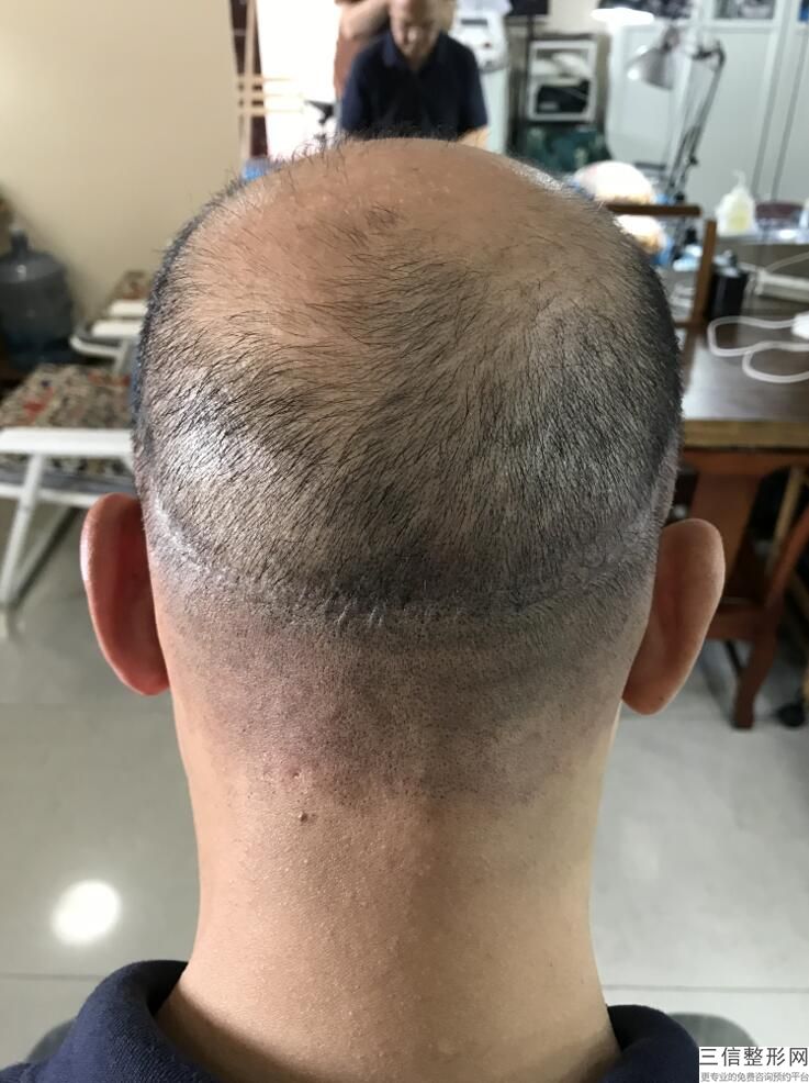 宁波植发医院排名表目录查询,2022宁波碧莲盛植发医院位列前十