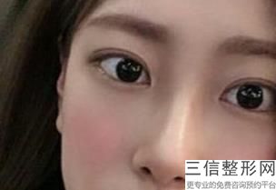 宁波做双眼皮医院排名前五,2022宁波圣爱医院医疗美容不容错过