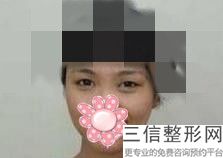 宁波做双眼皮医院排名前五,2022宁波壹加壹整形美容医院实力上榜