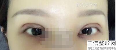青岛双眼皮修复医生排行榜前八名单新版推出,2022孙好杰口碑不错