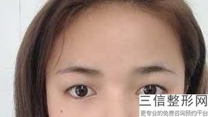 兰州割双眼皮医院排名榜前五对比盘点,2022兰州亚韩医学整形口碑不错