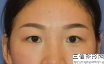兰州割双眼皮医院排名推荐三家,2022兰州皙妍丽医疗美容医院实力上榜