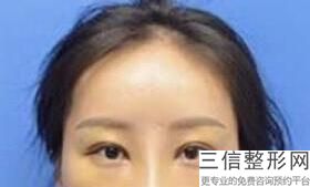 兰州好的双眼皮整形医院排名发布,2022兰州锦华医疗整形科实力上榜