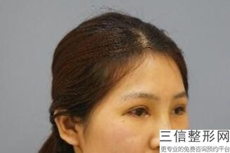 兰州哪里做双眼皮手术良好,2022兰州美示医疗美容整形实力超强