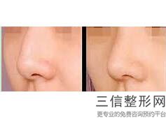 兰州膨体隆鼻哪家好,2022兰州时光激光整形美容医院口碑良好