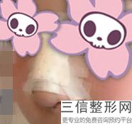 兰州膨体隆鼻哪家好,2022兰州亚韩医学整形外科医院不容错过