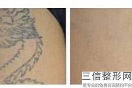 兰州做热玛吉的公立医院排行榜,2022甘肃省人民医院整形科实力非凡