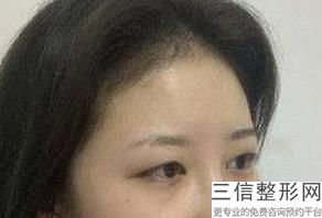 兰州做双眼皮医院哪家好,2022兰州皙妍丽整形美容门诊部实力超强