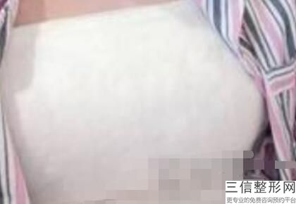 隆胸医院哪个好,2022南方医科大学南方医院整形科口碑良好