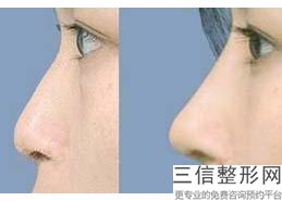洛阳鼻综合整形医院哪家好,2022洛阳孔繁荣医疗美容门诊部口碑不错