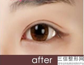 洛阳整形医院有哪些做双眼皮好,2022洛阳中心医院整形美容中心位列前十